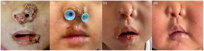 Successfully treated with siltuximab and prednisone in a 7-year-old girl with DOCK8-deficiency presenting as recurrent wart-like lesions: a case report